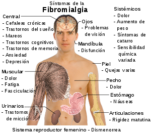 Síntomas de la fibromialgia